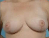 Patient # 62433 After Photo # 2